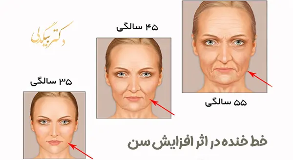 خط خنده در پیری