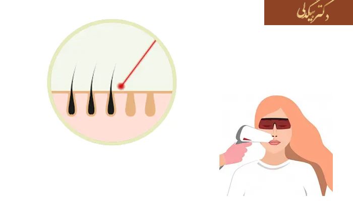 لیزر موهای زائد صورت چیست؟